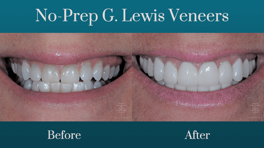 No-prep G. Lewis Veneers